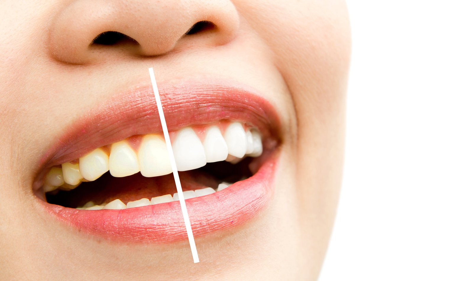 Teeth whitening treatment
